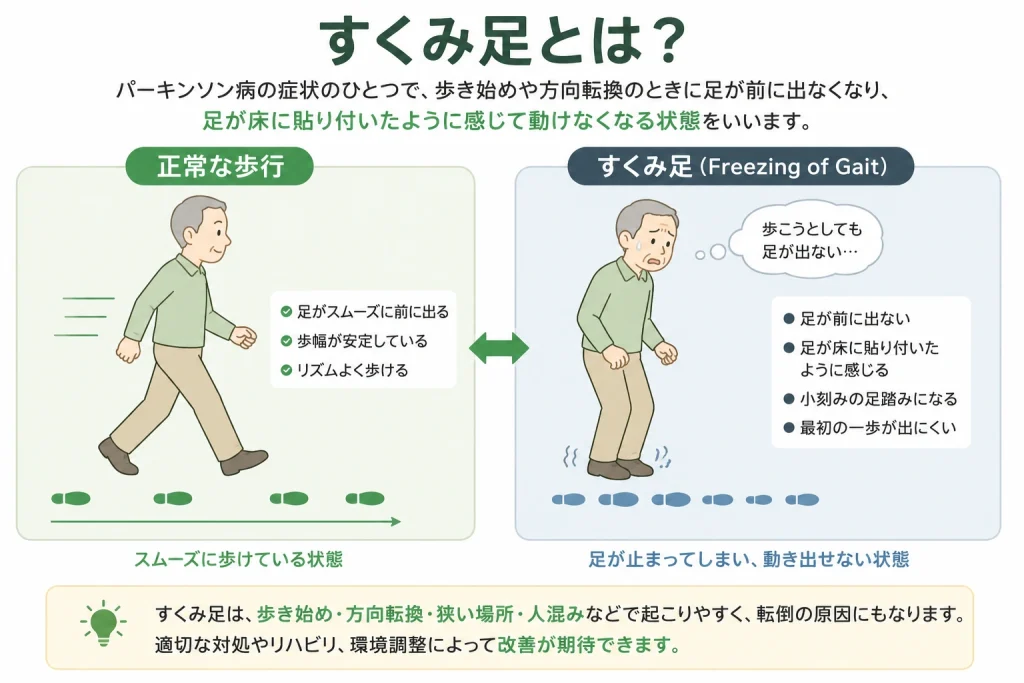 パーキンソン病のすくみ足とは？