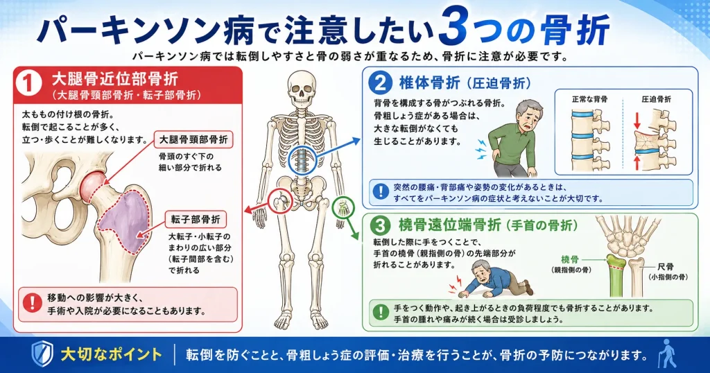 パーキンソン病で注意したい3つの骨折
