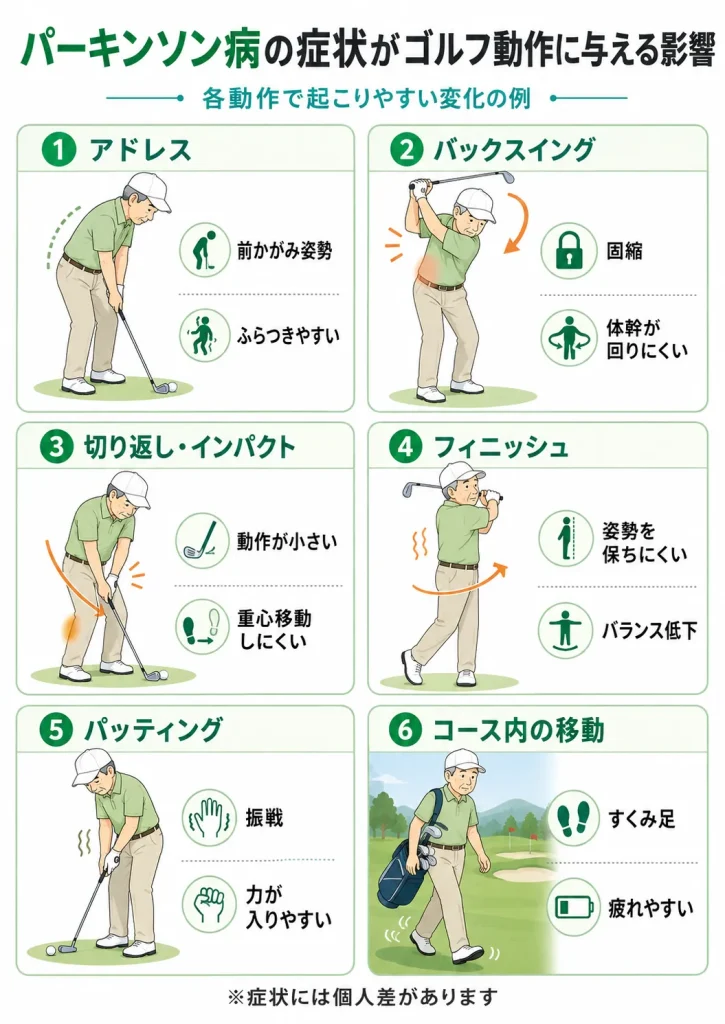 パーキンソン病の症状がゴルフ動作に与える影響