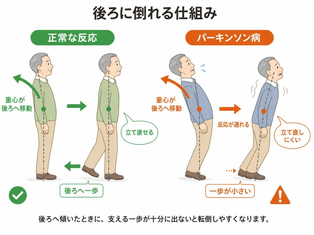 パーキンソン病＿後ろに倒れる