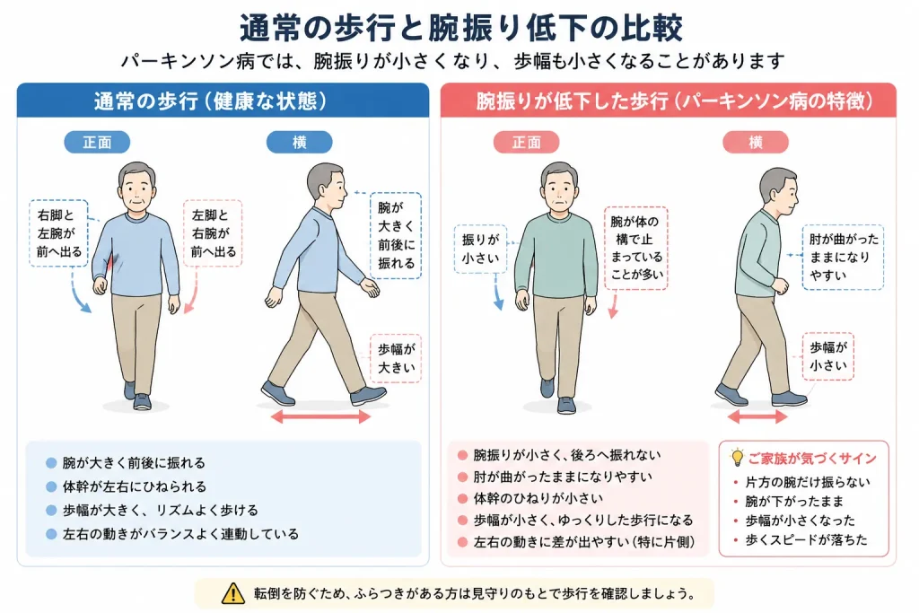 通常の歩行と腕振り低下の比較