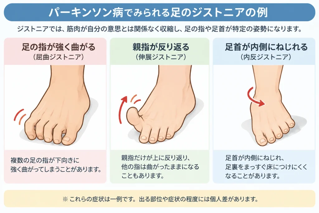 パーキンソン病でみられる足のジストニア