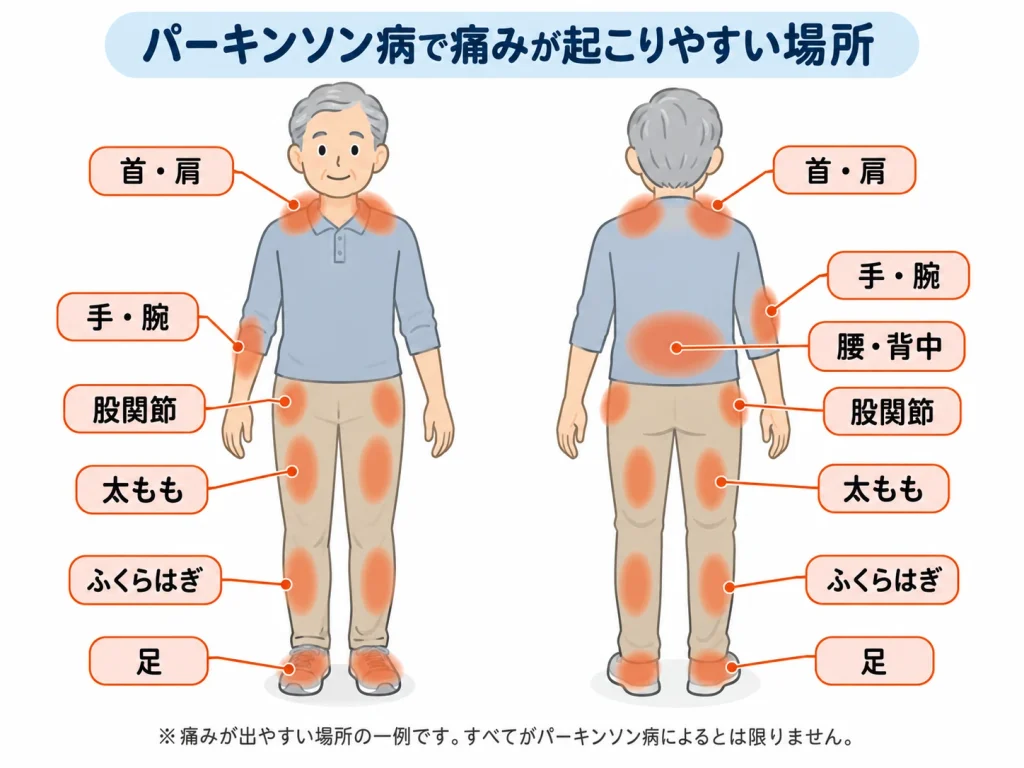 パーキンソン病で痛みが起こりやすい場所