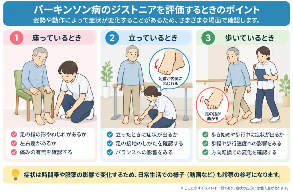 パーキンソン病のジストニアを評価するときのポイント