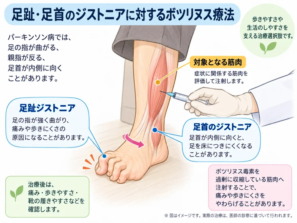 足趾_足首ジストニアのボツリヌス療法